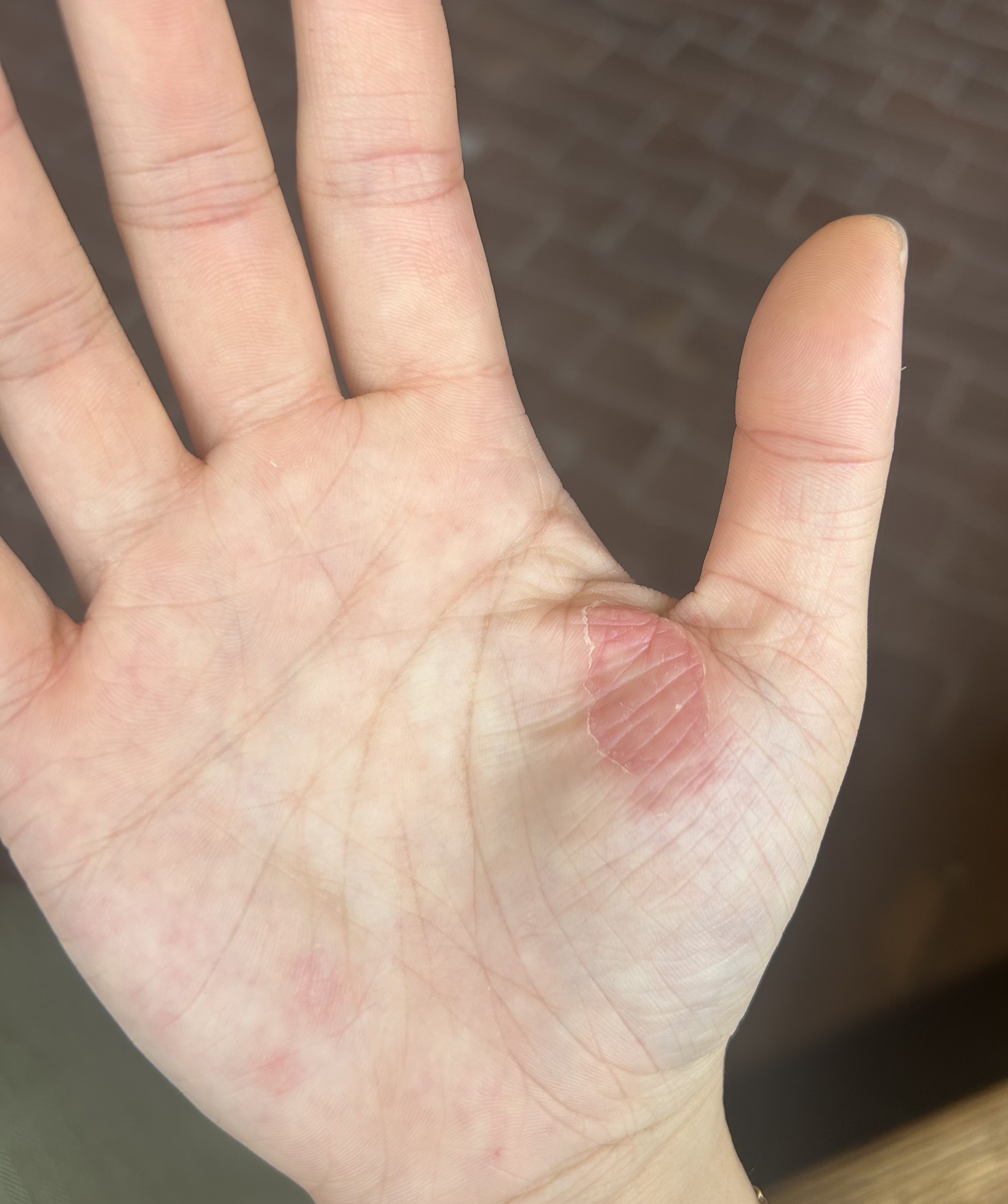 Eczema on hand