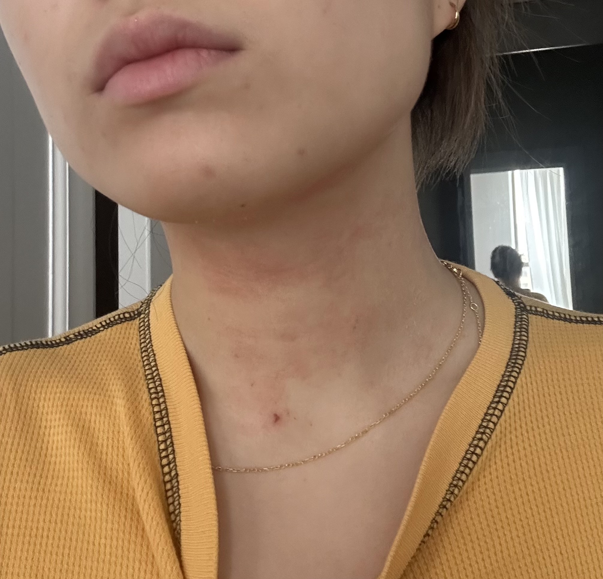 Eczema on neck